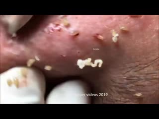 porn воспаленные прыщи корочки черные точки porn