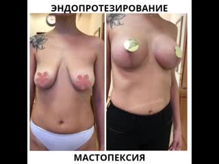 porn эндопротезирование молочных желез и мастопексия porn