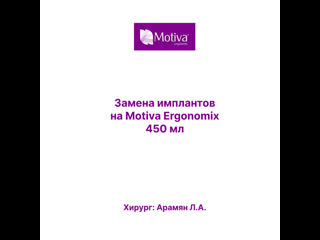 porn результат вторичной маммопластики и замены имплантов на motiva ergonomix porn
