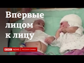porn лицом к лицу в первый раз в израиле разделили сросшихся затылками близнецов porn