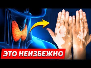 porn что такое витилиго как правильно лечить белые пятна porn