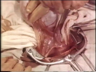porn овариоэктомия удаление яичников при раке молочной железы oophorectomy removal of the ovaries porn