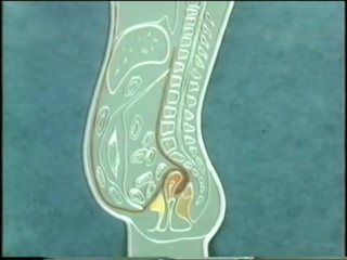 porn опущение и выпадение матки и влагалища prolapse of the uterus and vagina porn