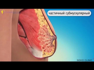 porn естественная грудь только анатомические импланты нет с помощью круглых имплантатов хирург тоже может создать porn