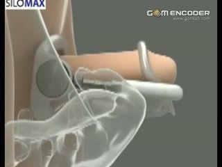 porn увеличение члена пениса экстендер большой огромный длинный толстый хуй удлинениебез операции хера porn