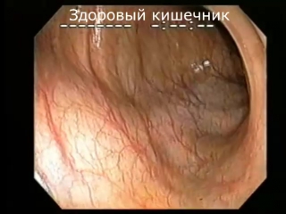 porn колоноскопия кишечника под наркозом процедура очищение организма от шлаков и токсинов в домашних условиях отзывы porn
