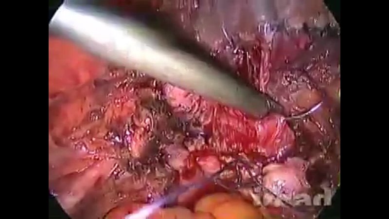 porn laparoscopic trachelectomy and partial cystectomy for the management of recurrent bladder endometriosis after porn