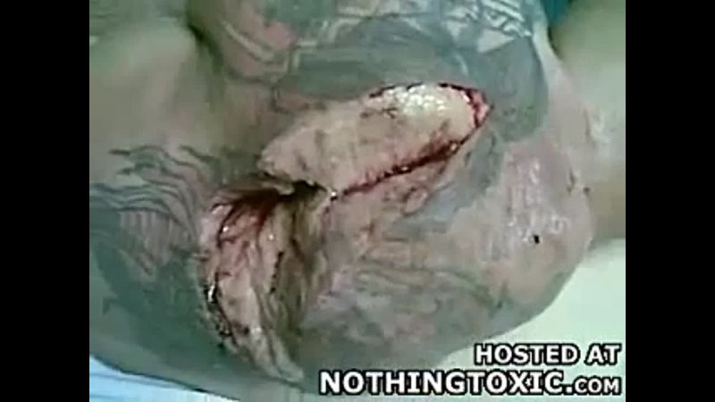 porn лопнула мышца порвалась мышца бицепц porn