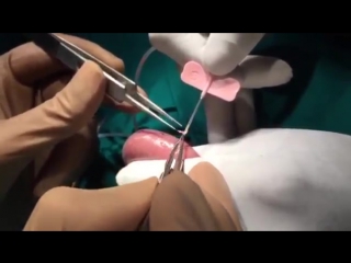 porn tese icsi testicular sperm extraction using the needle biopsy technique porn
